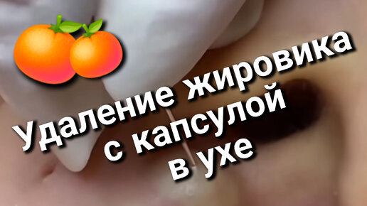 У девушки появилась ШИШКА в ухе 🍊 Косметолог удаляет ЖИРОВИК с капсулой.