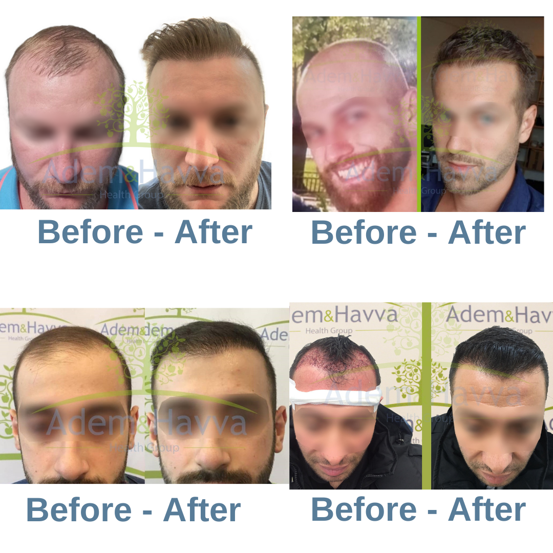 Hair Transplant Before After