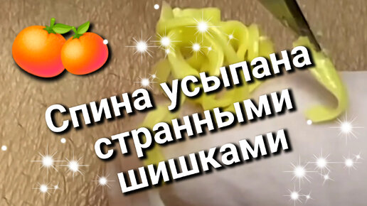 Выдавливание СТЕАТОЦИСТОМ на спине у мужчины 🍊 Оказывается это генетическое заболевание..