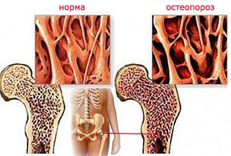 Как выглядит костная ткань при норме и остепорозе.
