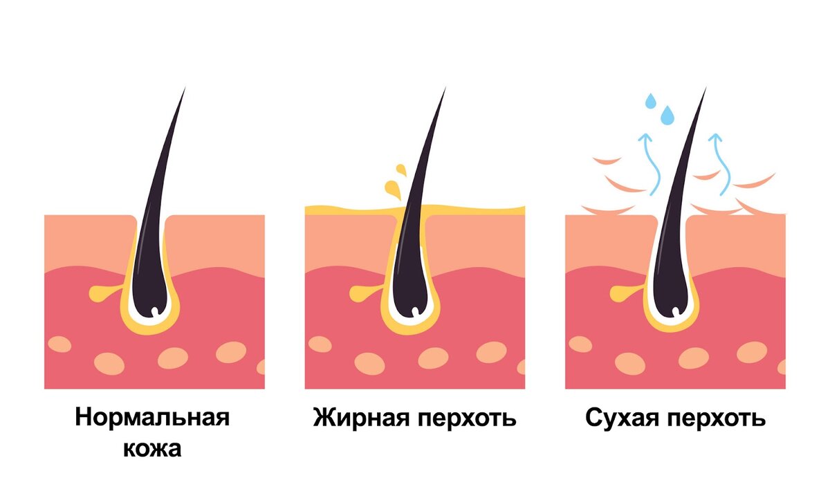 Перхоть: почему она появляется на самом деле? Топ-6 причин — и как  избавиться от перхоти? Объясняет эксперт | IQ Ladies | Блог  нейрокосметолога Алевтины Коротовской | Дзен