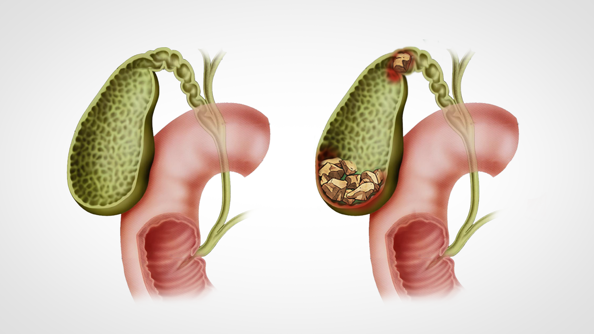 почему желчный пузырь болеет