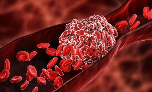 https://www.naturalnews.com/wp-content/uploads/sites/91/2024/05/blood-clot-arm-2.jpg  https://www.naturalnews.com/2024-05-01-astrazeneca-finally-admits-covid-vaccine-causes-thrombosis.html