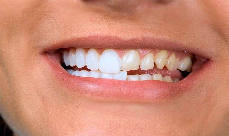 Способы получить идеальные зубы, как у знаменитостей.
