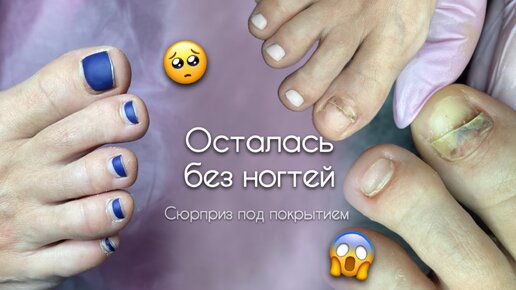 ОТДАВИЛИ НОГТИ. Неприятный сюрприз под гель-лаком. Клиентка осталась без ногтей 😢