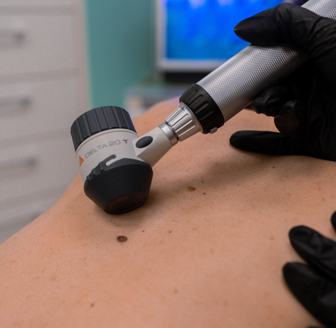 Родинки, или невусы, являются доброкачественными образованиями на коже. Они могут быть разных размеров, форм и цветов. В большинстве случаев родинки не представляют опасности для здоровья, но иногда они могут перерождаться в злокачественные опухоли.