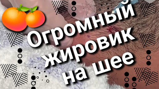 Появилась ОГРОМНАЯ шишка, БЕГИ к врачу и не жди 🍊 Удаление жировика на шее