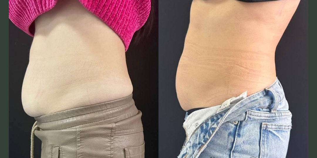 Результат клиента ДО и ПОСЛЕ сеанса ручной коррекции живота 🔥