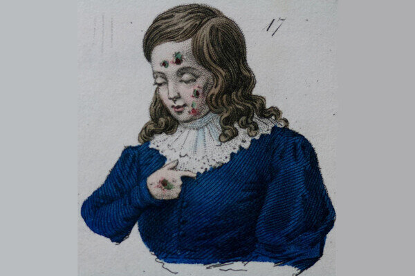    Иллюстрация из книги Jean Giraudeau de Saint-Gervais «Trait? des maladies syphilitiques», Paris, 1838 / Из личной коллекции профессора Дениса Заславского