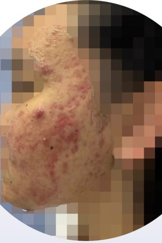 На фото до начала лечения у Солодкой Т.В.