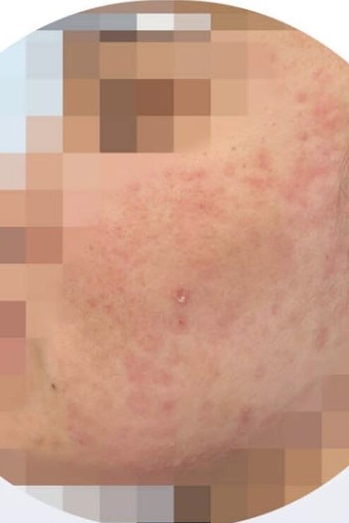 На фото промежуточный результат лечения