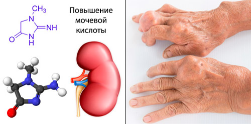 Повышена мочевая кислота в крови – может ли это быть признаком подагры и как ее правильно снизить?