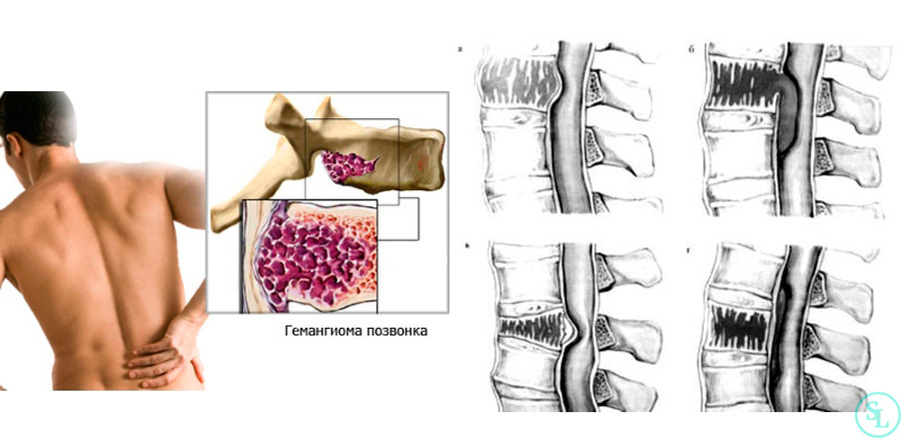 Гемангиома сдавливает спинной мозг