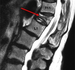 Патологический перелом 12 грудного позвонка.