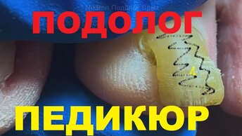 Осторожно, омертвевшая кожа и вросшие ногти Чистка Давим Прыщи #Педикюр #Прыщи #Косметолог №3