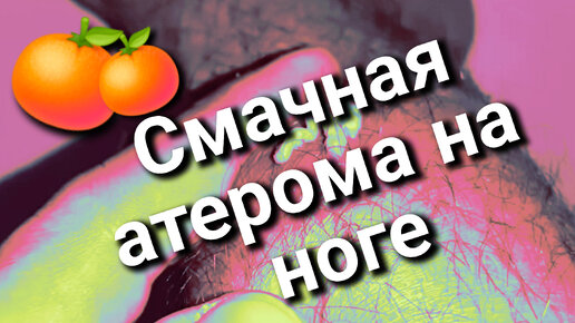 Этот парень не из РОБКИХ.. Смачная АТЕРОМА на ноге 🍊 Как же не легко она давится..