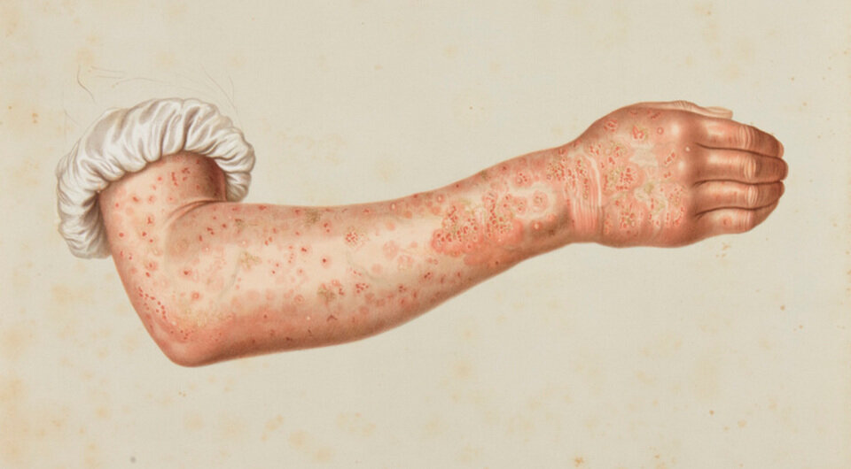   Historical Illustrations of Skin Disease: Selections from the New Sydenham Society Atlas 1860-1884 / Yale University Library / Public Domain