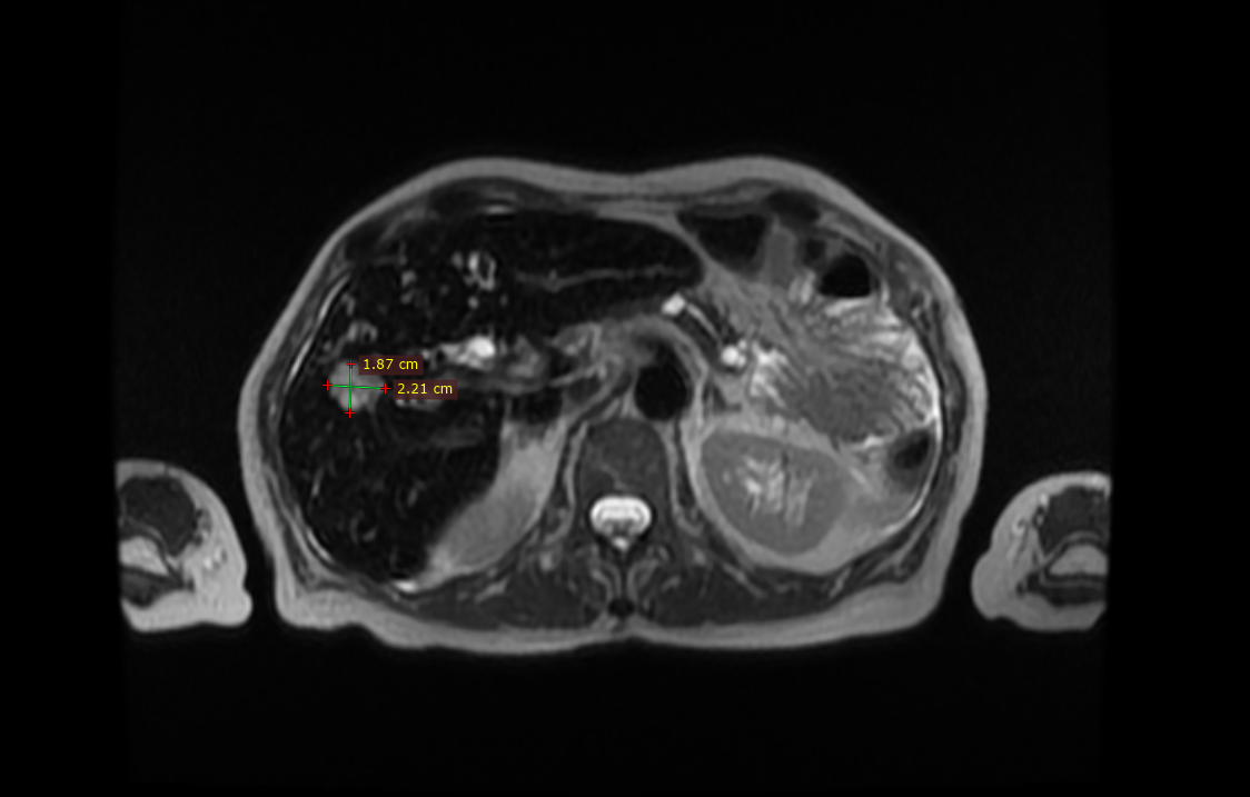Метастаз рака поджелудочной железы в правой доле печени
