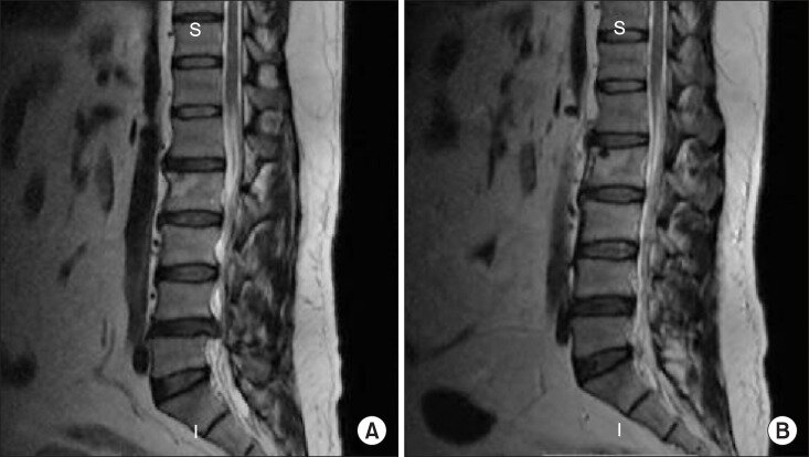 МРТ пациента, сагиттальные изображения МРТ пациента, который сообщил о выздоровлении через 7 месяцев после лечения. 