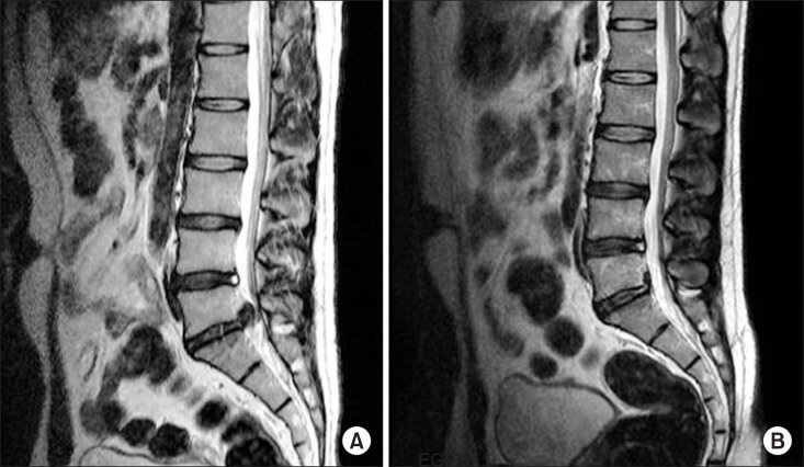 Сагиттальные снимки МРТ другого пациента с ЛДГ до (А) и после лечения (Б). Через 16 месяцев после лечения у пациента не было симптомов