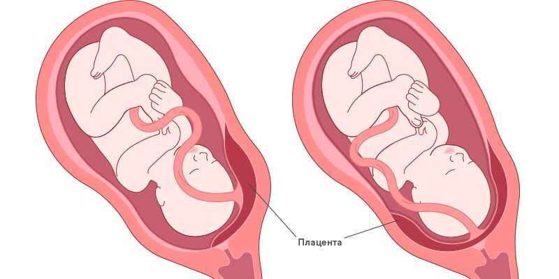 Предлежание сосудов пуповины