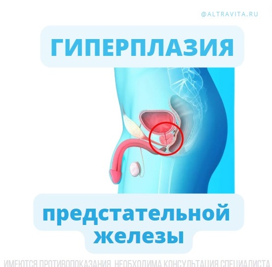 Доброкачественная гиперплазия предстательной железы