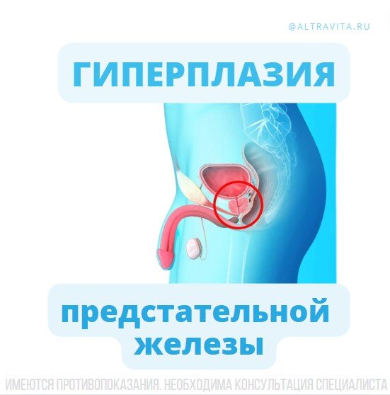 Гиперплазия предстательной железы