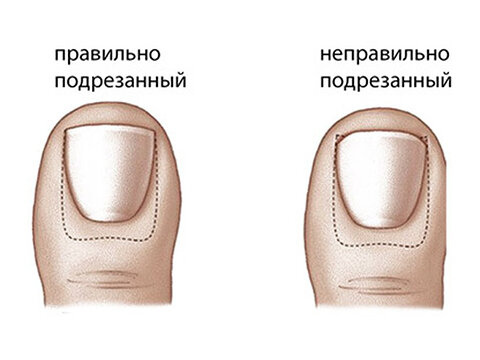 Как снимают ноготь ребенку