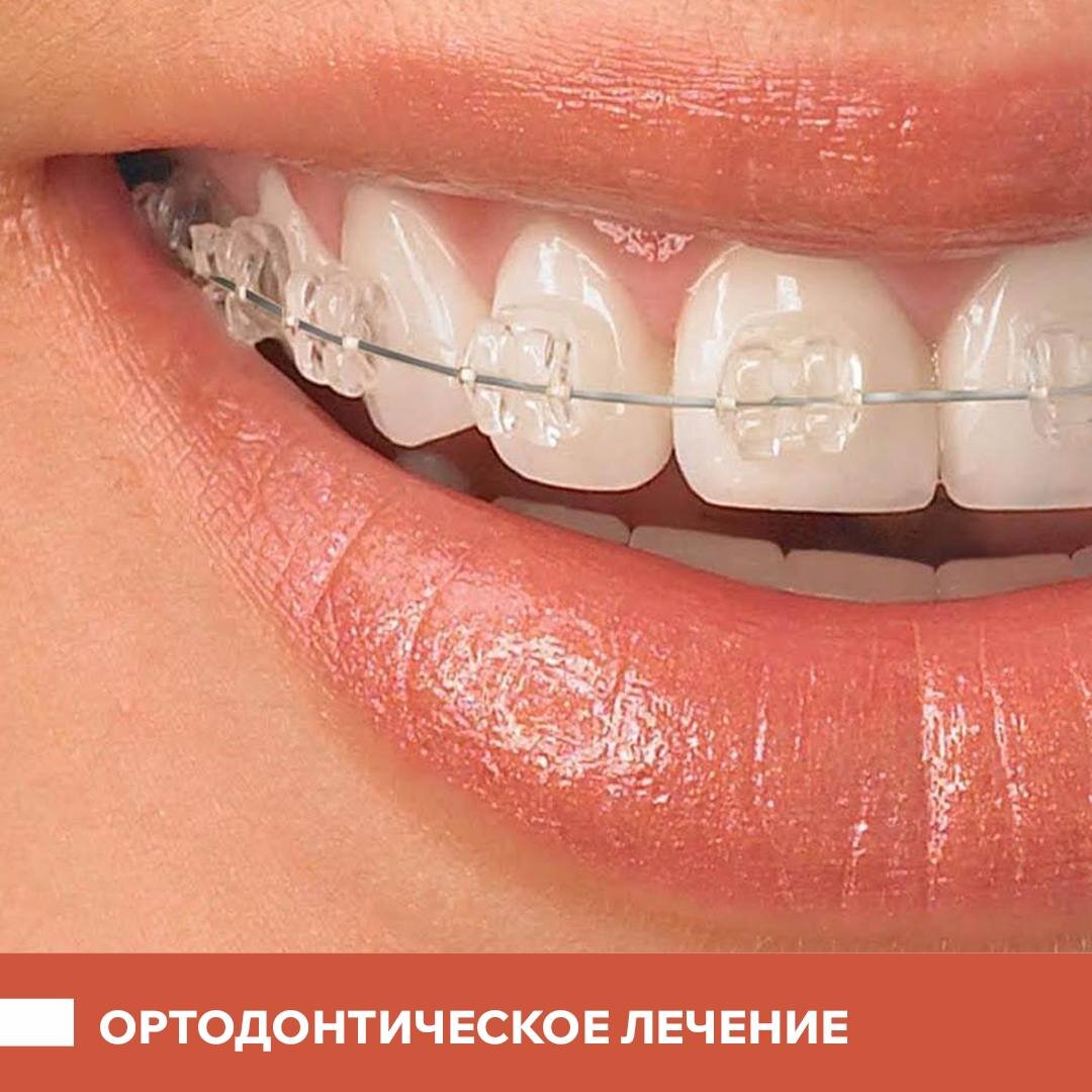 Суть лечения в том, что мы создаем давление с помощью брекет-систем на зубной ряд. Постепенно зубы «идут» в корректное положение.