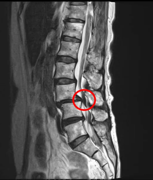 Стеноз позвоночного канала