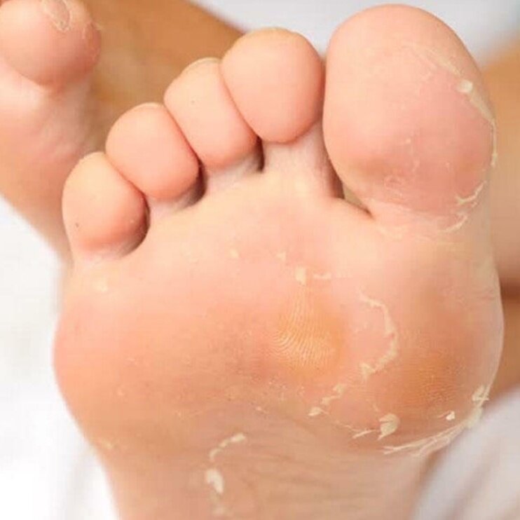 Шелушение кожи на стопе