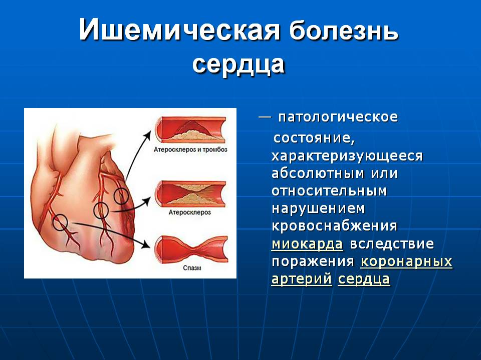 Ишемия передней стенки