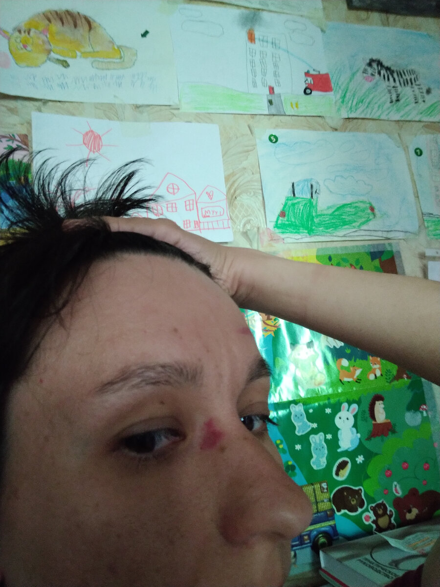 Абьюзеры бьют жертв по голове, чтобы не видно было синяков, но у меня появилось кровоизлияние  на лбу и на лице. Фото личный архив от 22.05.2024 г