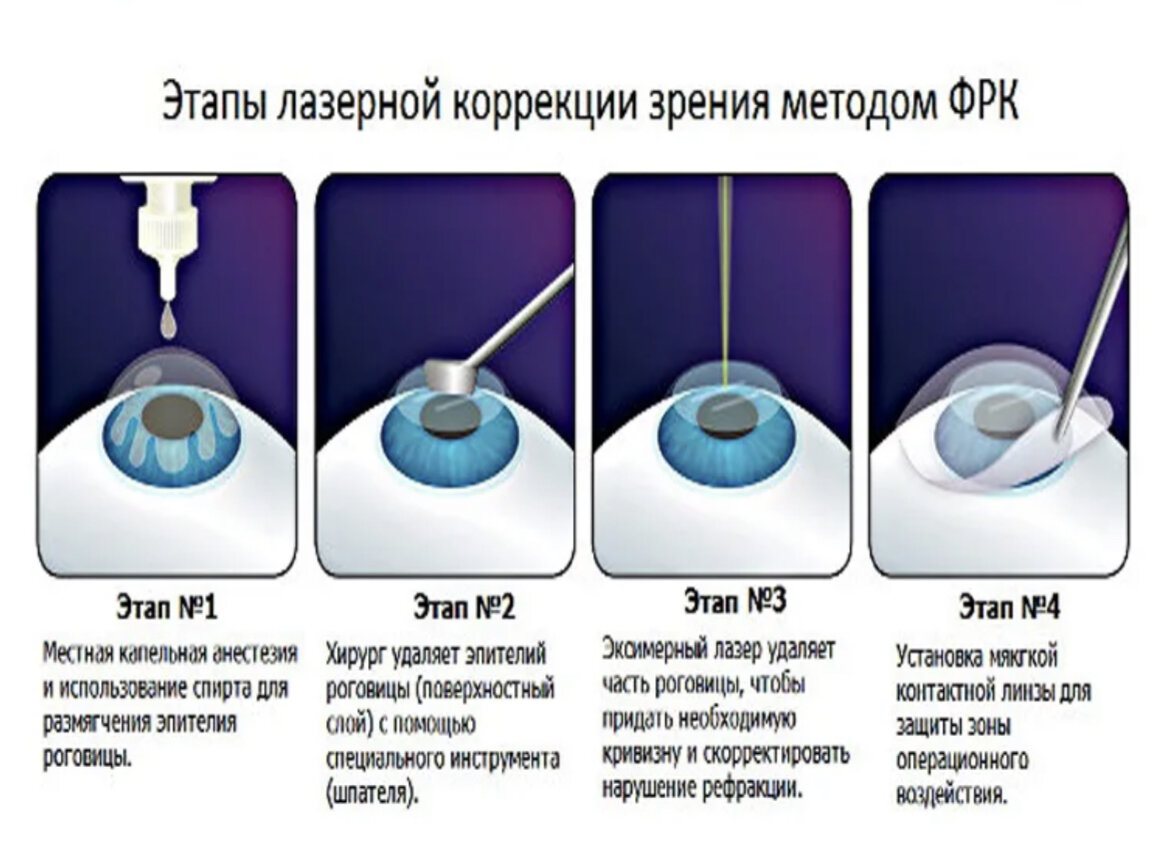 Коррекция зрения что нужно