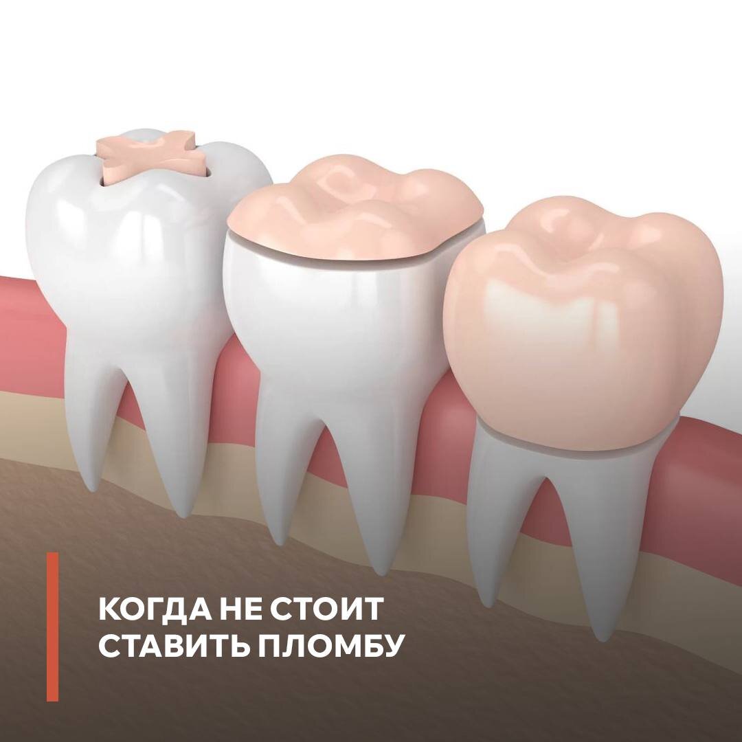 Если зуб разрушен более, чем на 50%, мы не рекомендуем устанавливать пломбу.