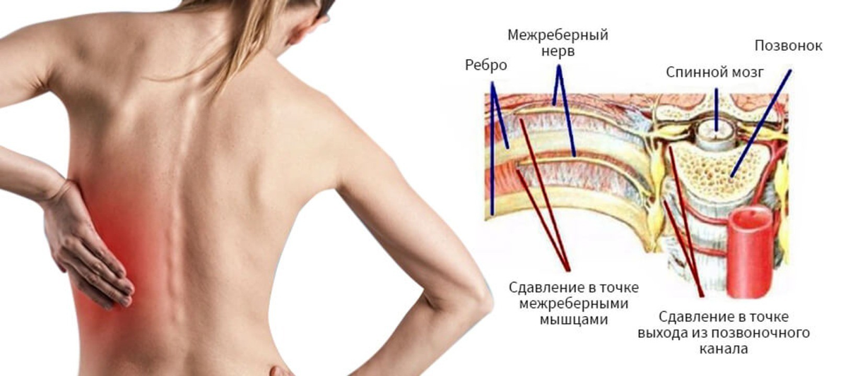 Межреберная невралгия баня