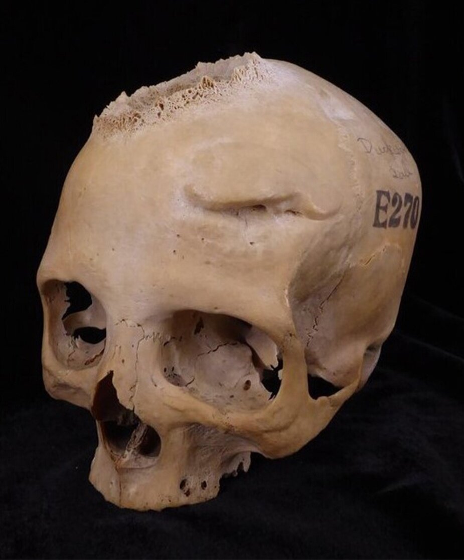 Череп 50-летней женщины Е270. Хорошо видны следы большой раковой опухоли справа. 
