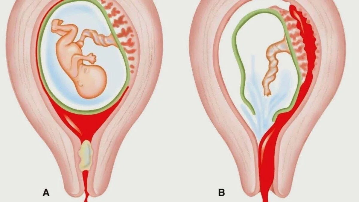 Причины выкидыша, лечение бесплодия, прогноз на будущее – поясняет врач клиники ISIDA