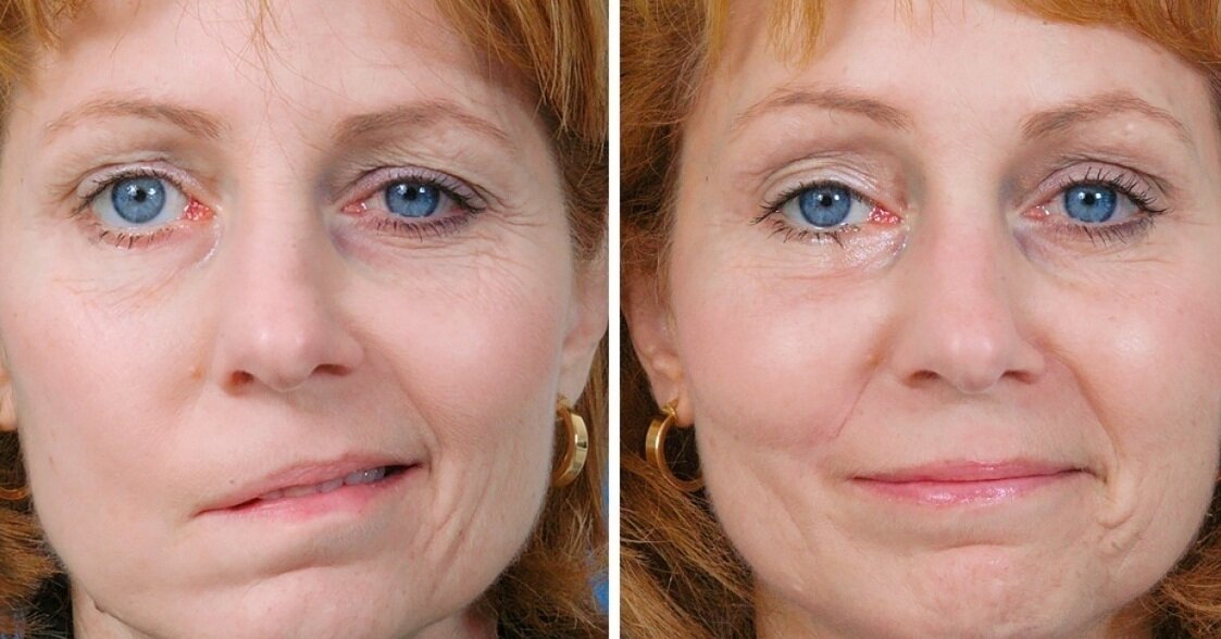 Демонстрация как может проявляться ишемический инсульт в правой СМА с парезом лицевого нерва по центральному типу и как может быть при своевременном введении тромболитика 