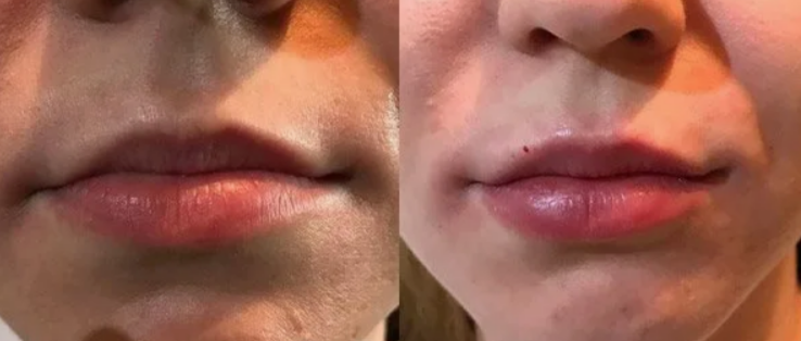 До и После применения препарата