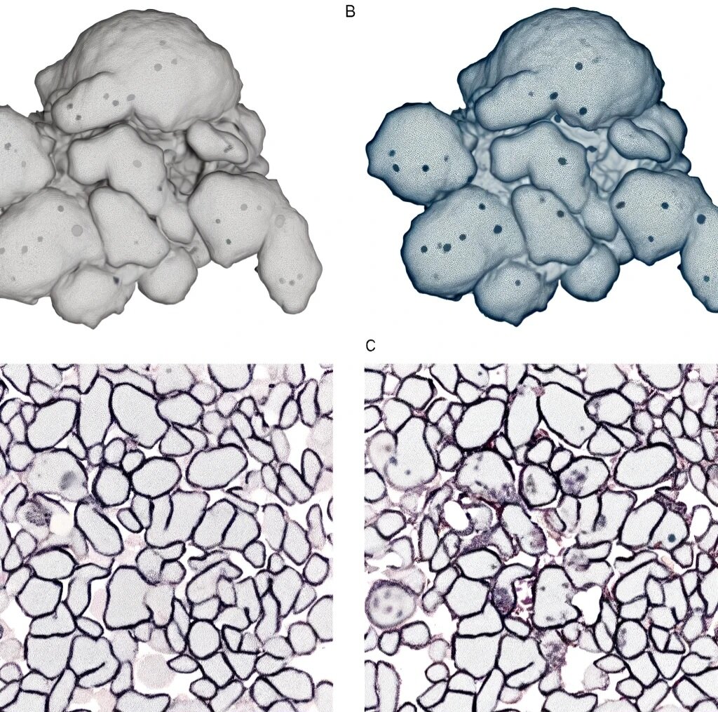 Раковые клетки под микроскопом