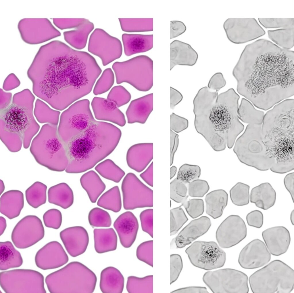 Раковые клетки под микроскопом