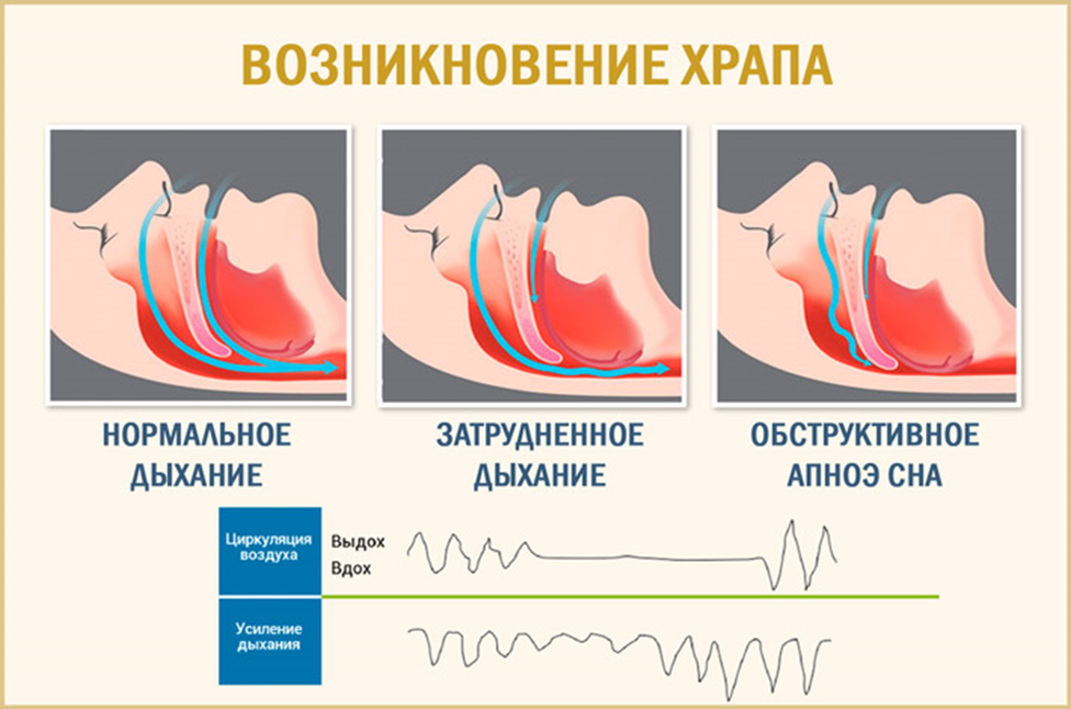 Храп и апноэ