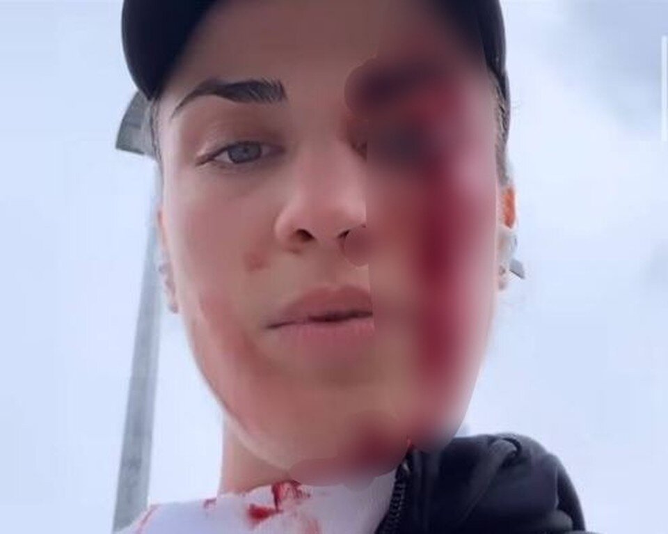    Девушка обратилась к тем, кто на неё напал сразу после случившегося. Фото: соцсети Аминат Эльбукаевой