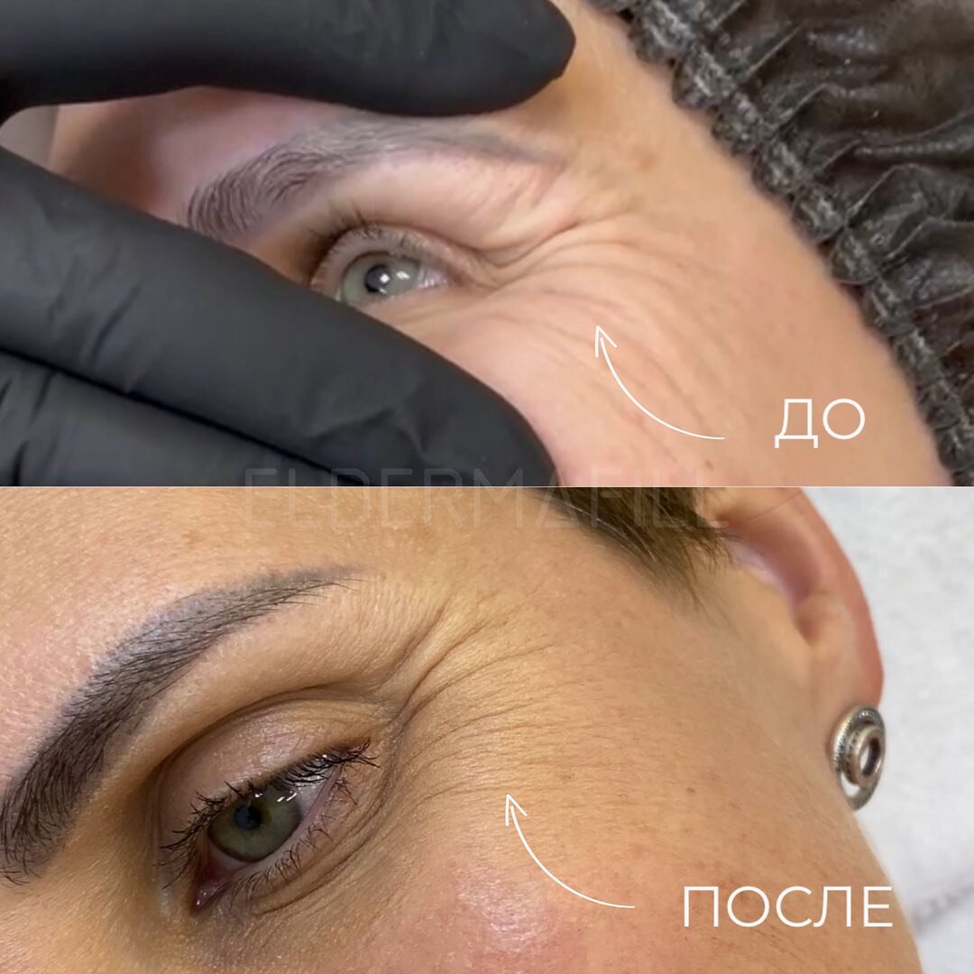 До/после препаратов Eldermafill после первого применения