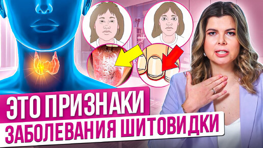 Tải video: Щитовидная железа, симптомы заболевания. Проблемы с щитовидкой. Заболевания щитовидной железы.