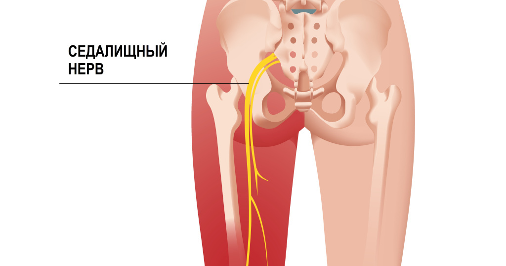 Ущемление седалищного нерва: причины, симптомы, лечение