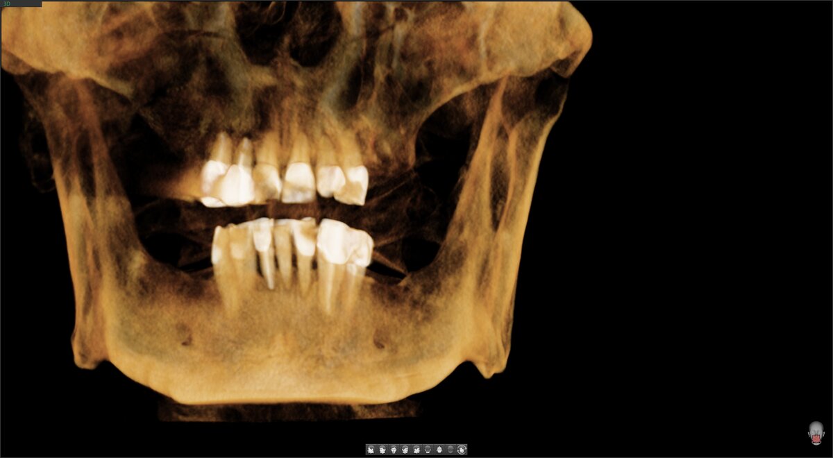 All-on-6 ("всё на 6") - нижняя челюсть