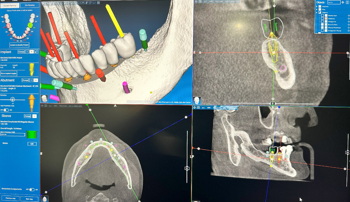 All-on-6 ("всё на 6") - нижняя челюсть