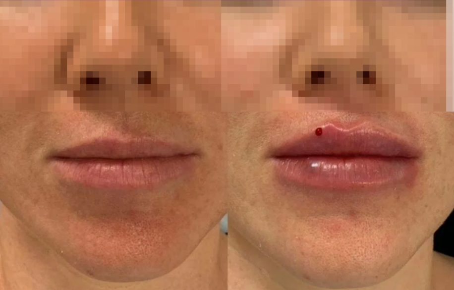 Увеличение губ. До и После